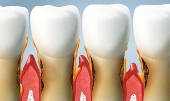 treat your teeth, periodontal