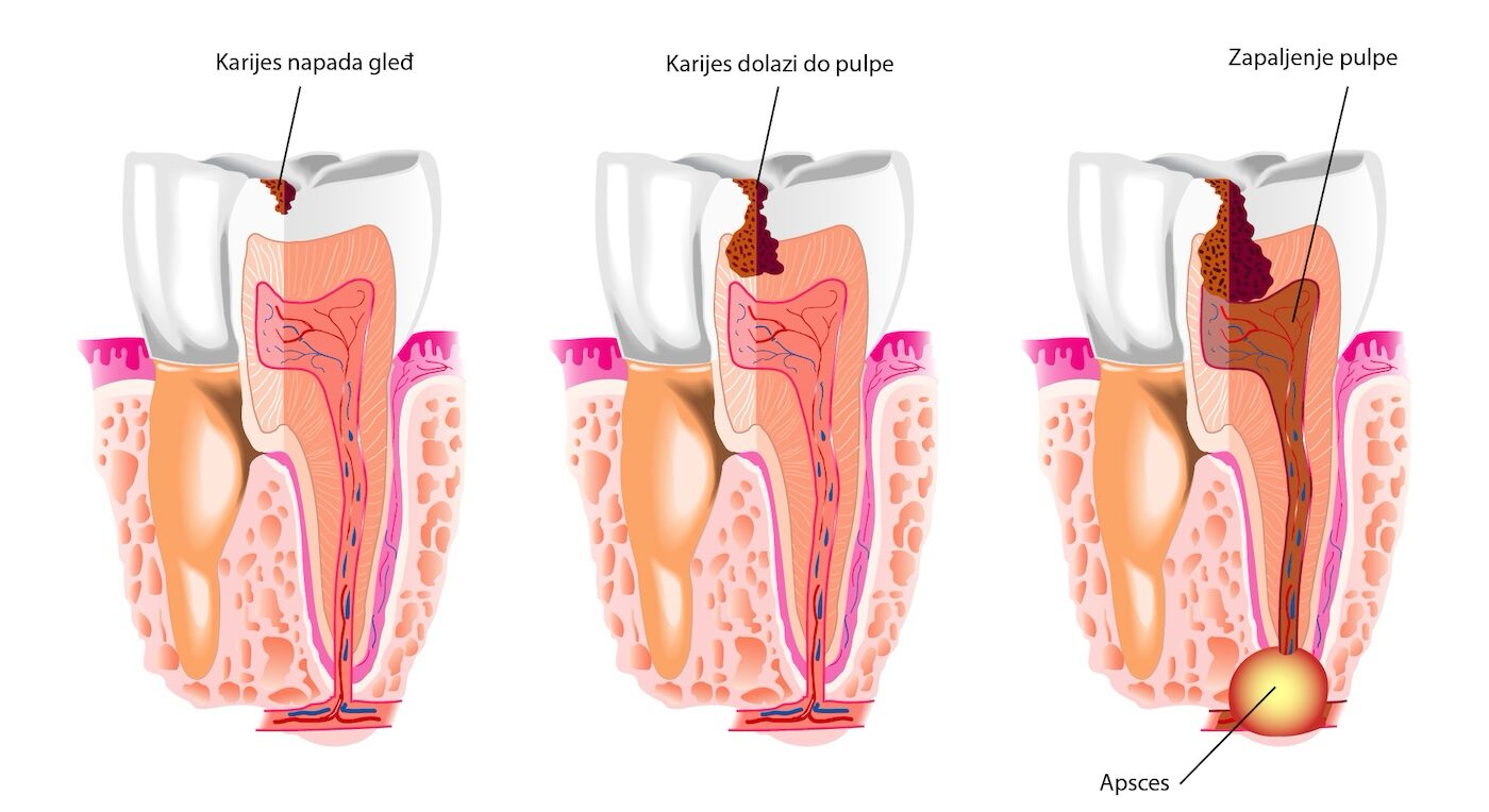 Pulpitis, bolna posledica nelečenog karijesa
