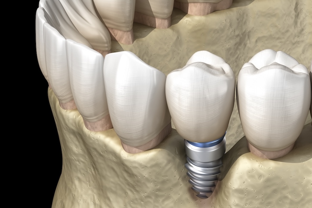 Koliko je opasan peri-implantitis?
