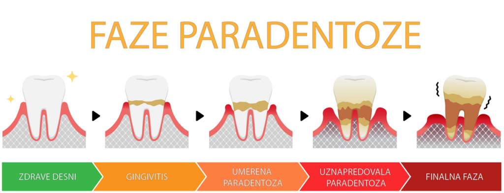 Paradontopatija: uzroci, simptomi, progresija i lečenje