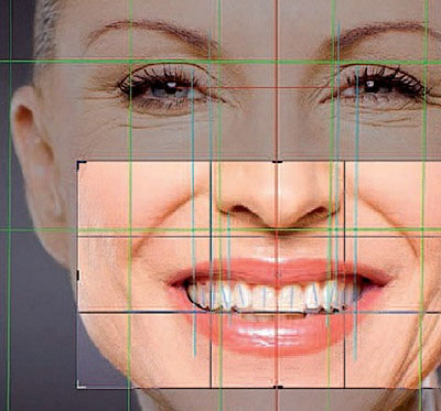 Šta je Digital Smile Design?