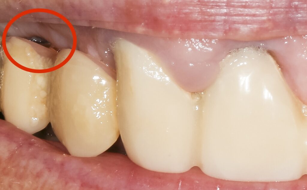Koliko je opasan peri-implantitis?