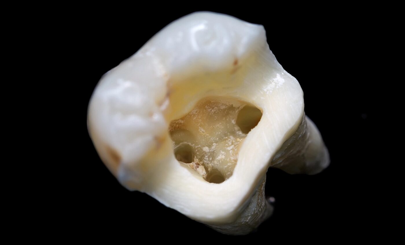 Pulpitis, bolna posledica nelečenog karijesa