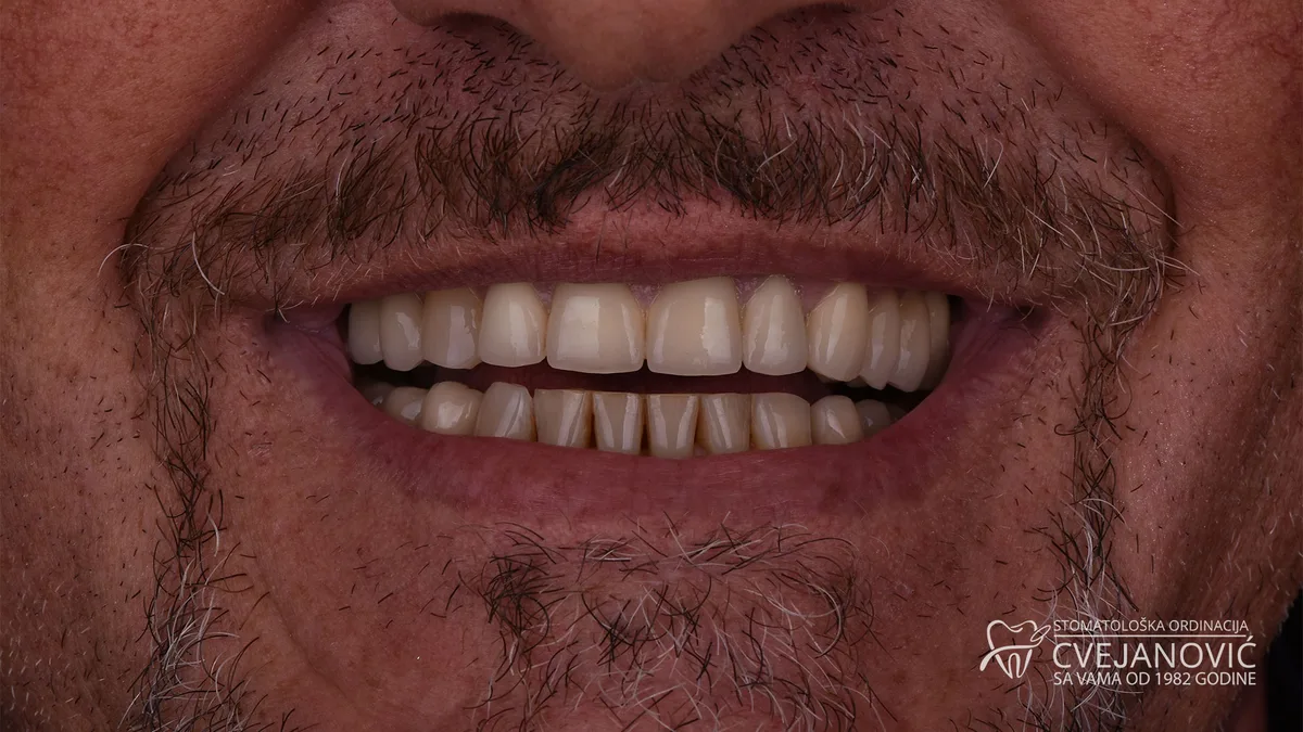 Hollywood smile, bezmetalne krunice — pre
