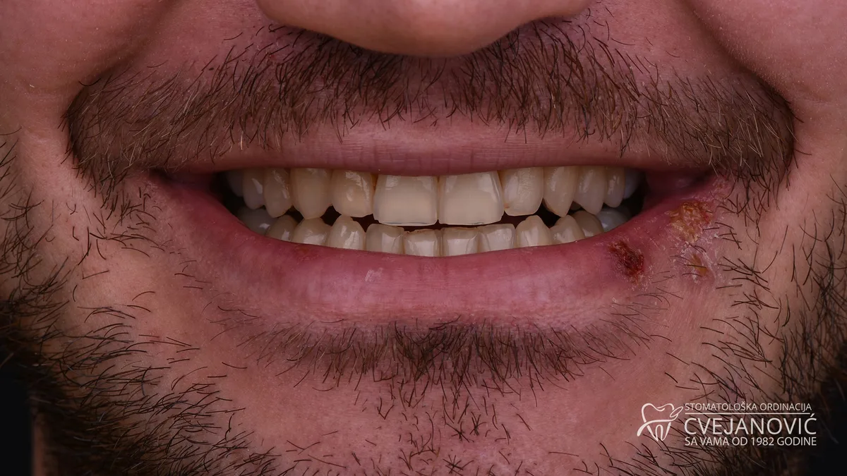 Hollywood smile, boja Bleach 2 — pre