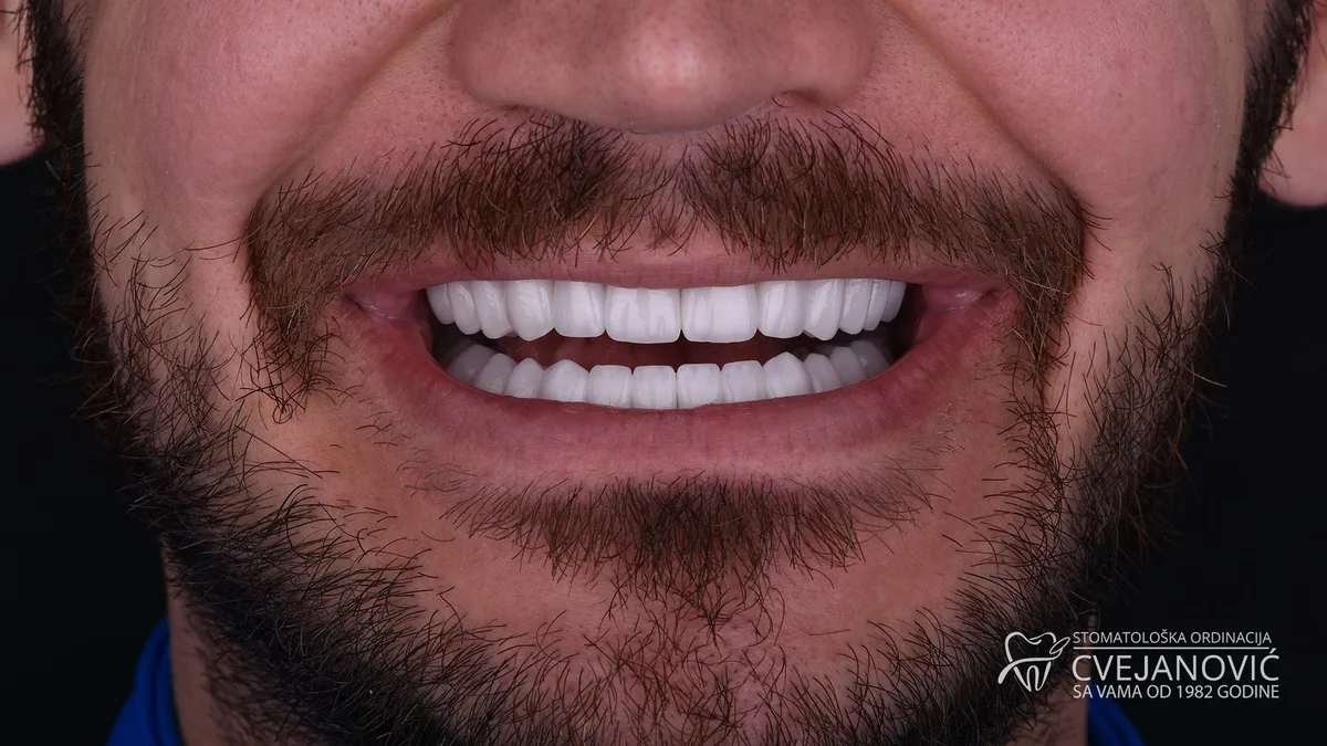 Hollywood smile, boja Bleach 2 — posle