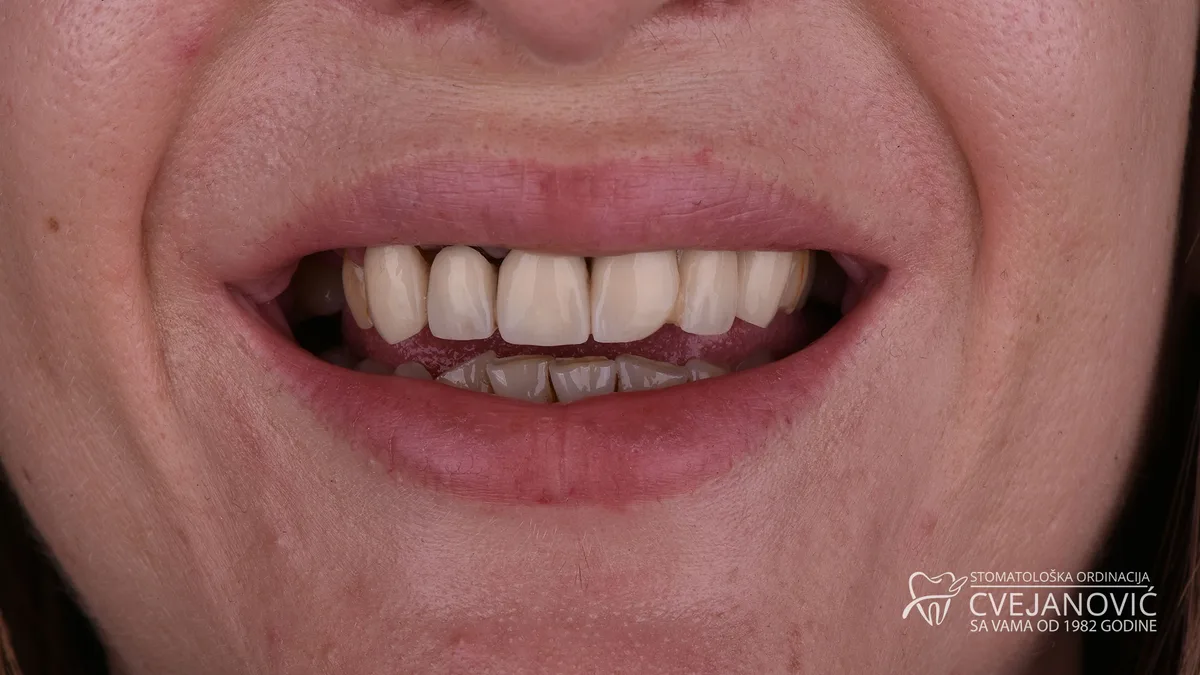 Hollywood smile, Bleach 2 — pre