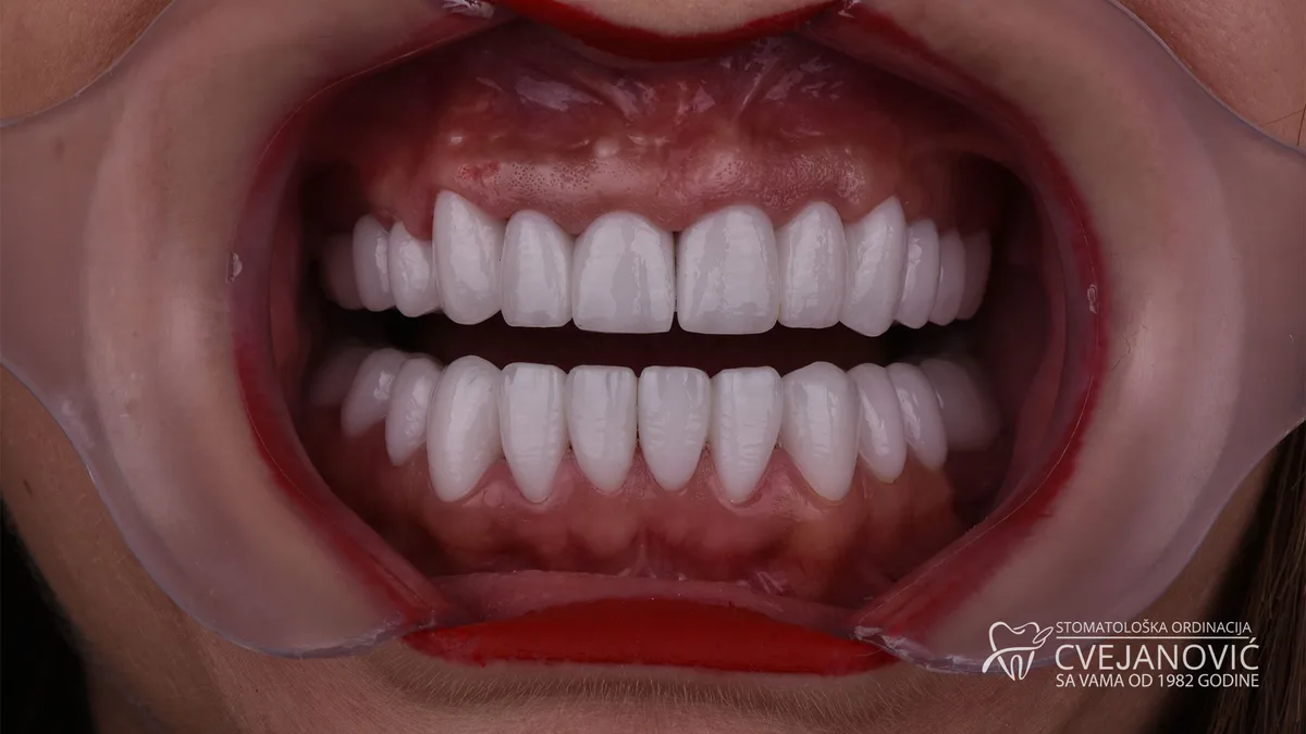 Hollywood smile, Bleach 2 — posle