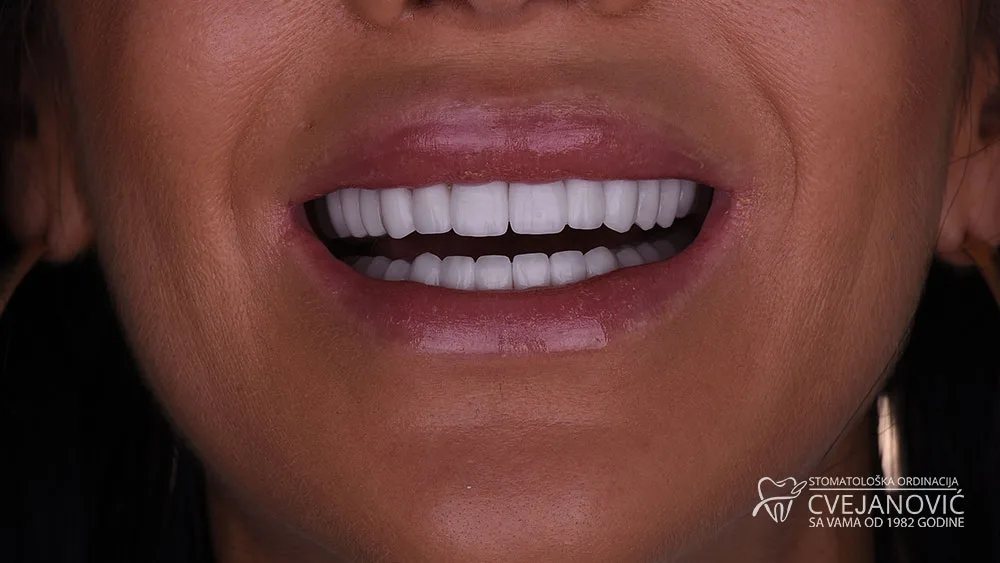 Hollywood smile – Bleach 2 — posle