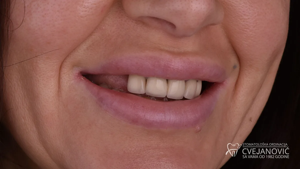 Hollywood smile, Bleach 2 — pre