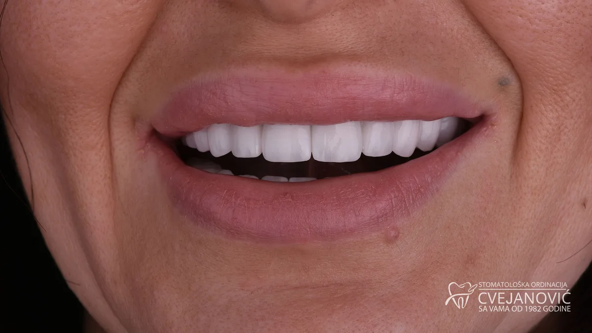 Hollywood smile, Bleach 2 — posle
