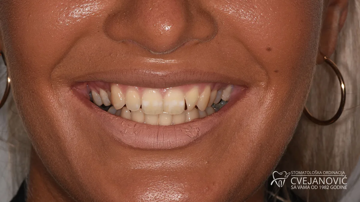 Hollywood smile – boja Bleach 3 — pre