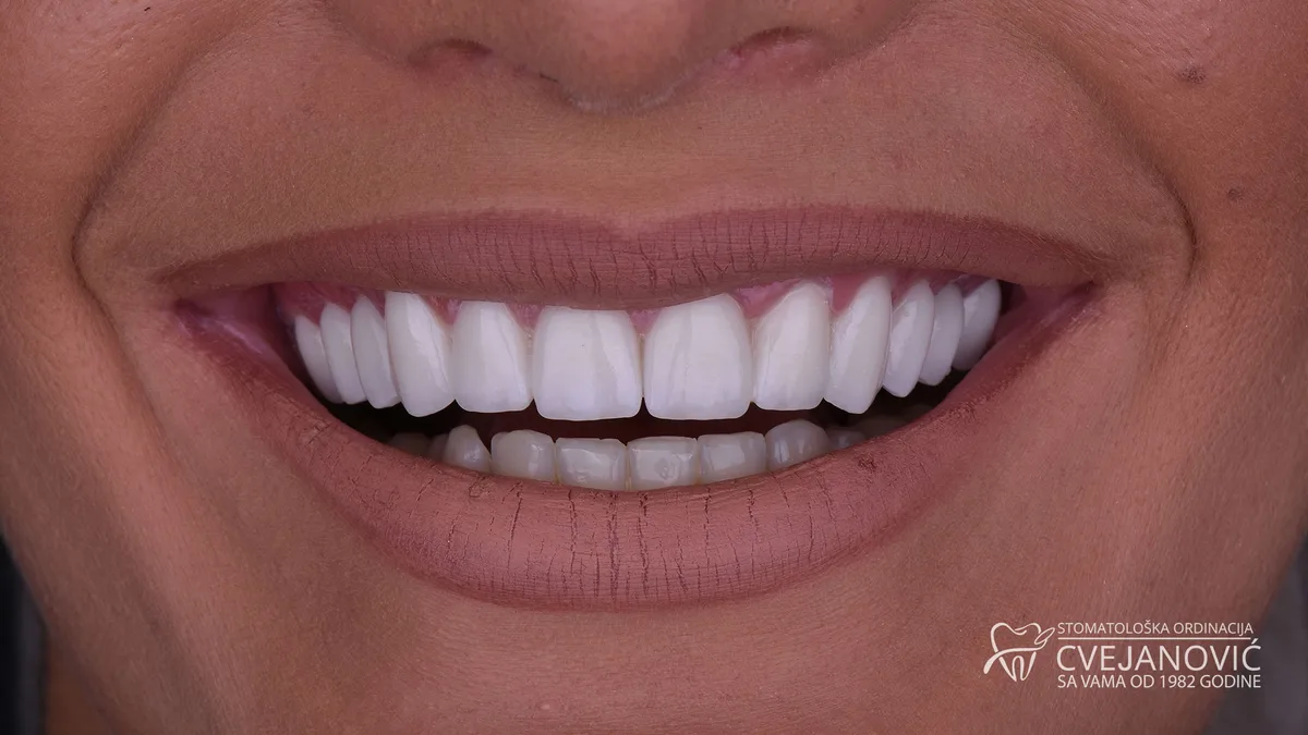 Hollywood smile – boja Bleach 3 — posle