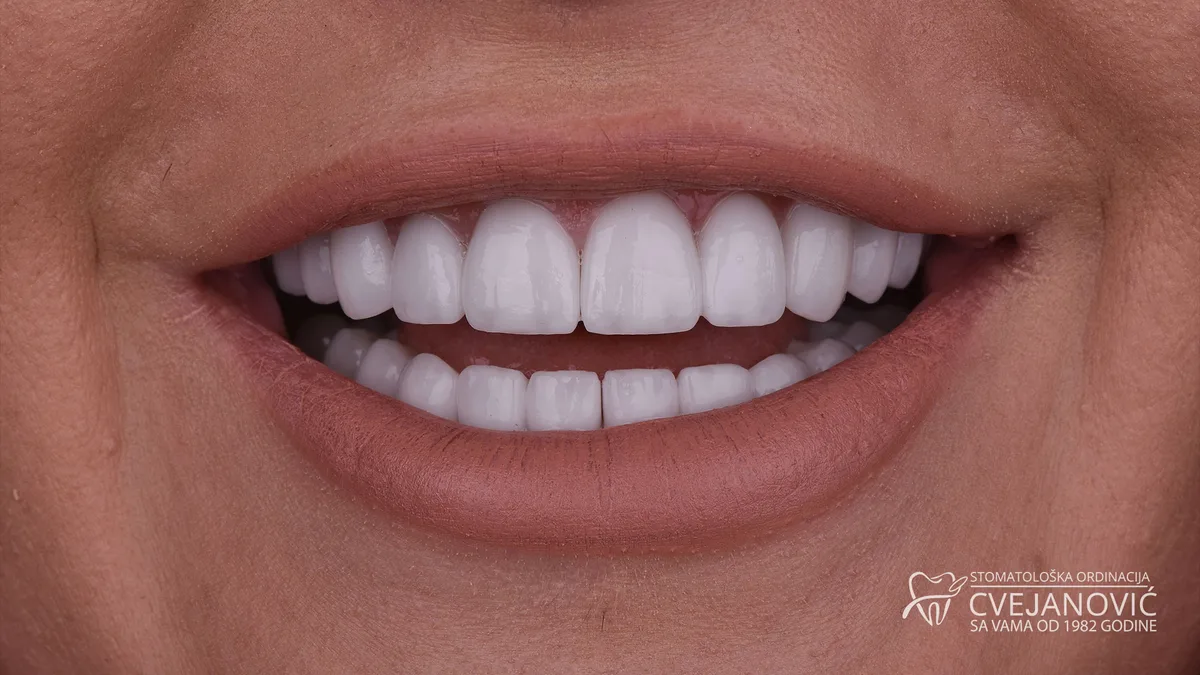 Hollywood smile, Bleach 1 — posle