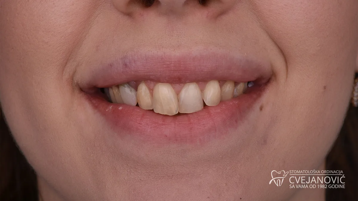 Hollywood smile, Kombinacija bezmetalnih i metalokeramičkih krunica — pre