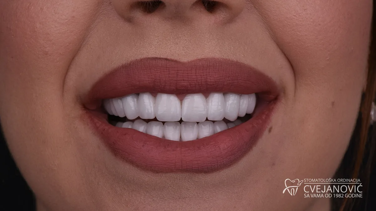 Hollywood smile, Kombinacija bezmetalnih i metalokeramičkih krunica — posle