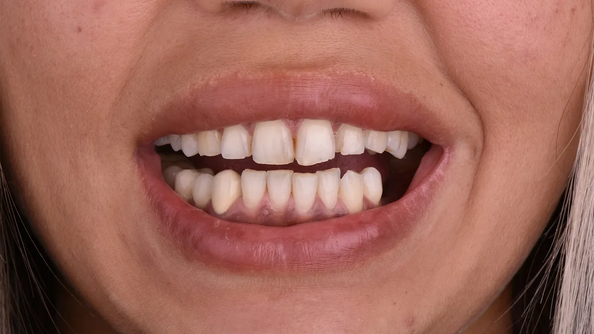 Hollywood smile – boja Bleach 1 — pre