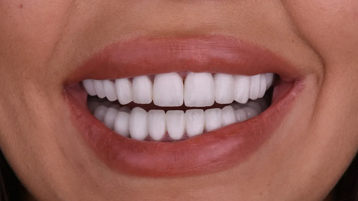 Hollywood smile – boja Bleach 1 — posle