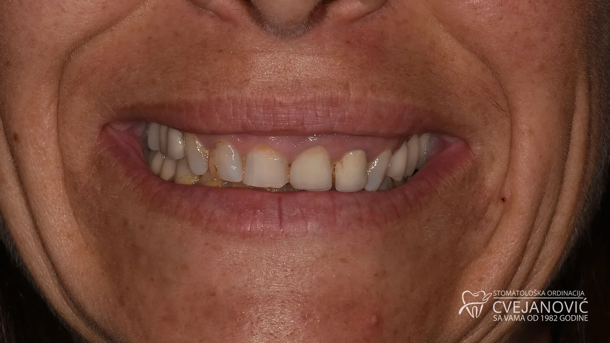 Hollywood smile, Bleach 3 + rešavanje gummy smile problema — pre