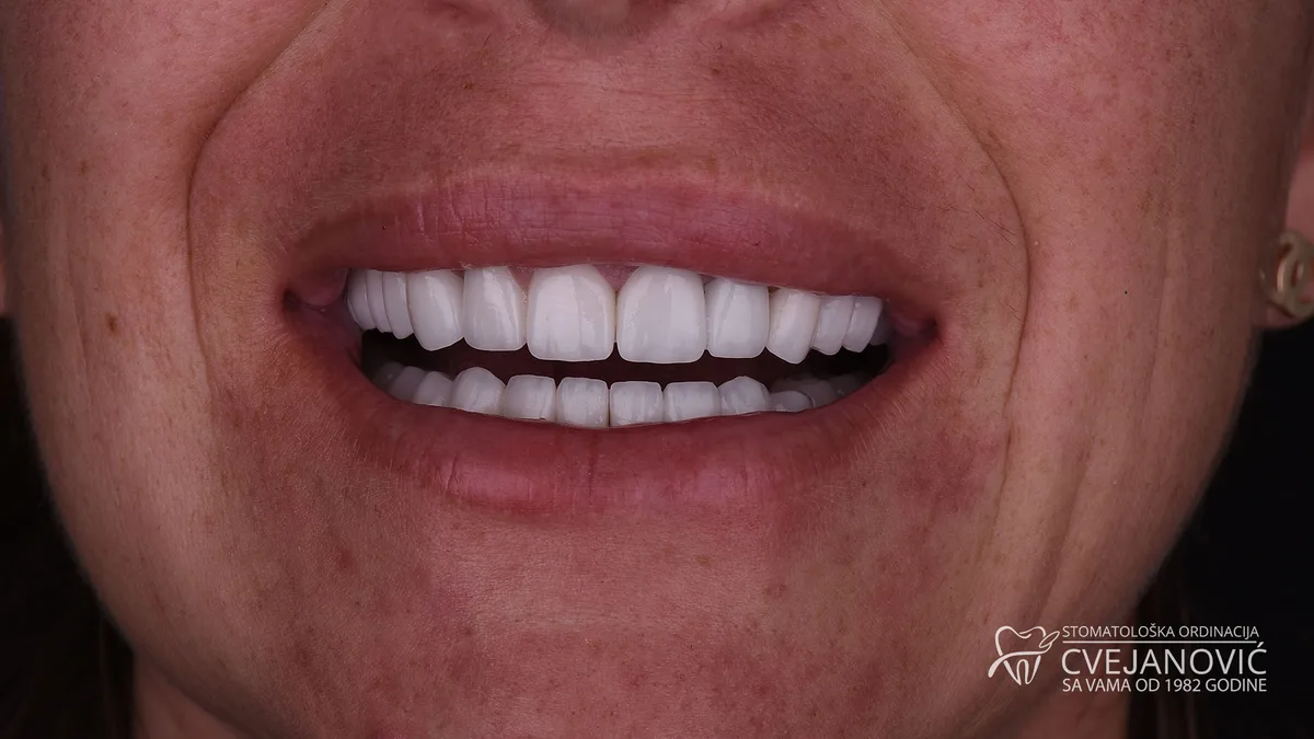 Hollywood smile, Bleach 3 + rešavanje gummy smile problema — posle