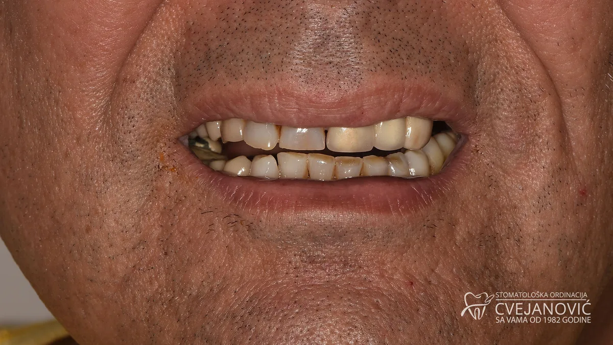 Hollywood smile za bračni par, Bleach 2 — pre