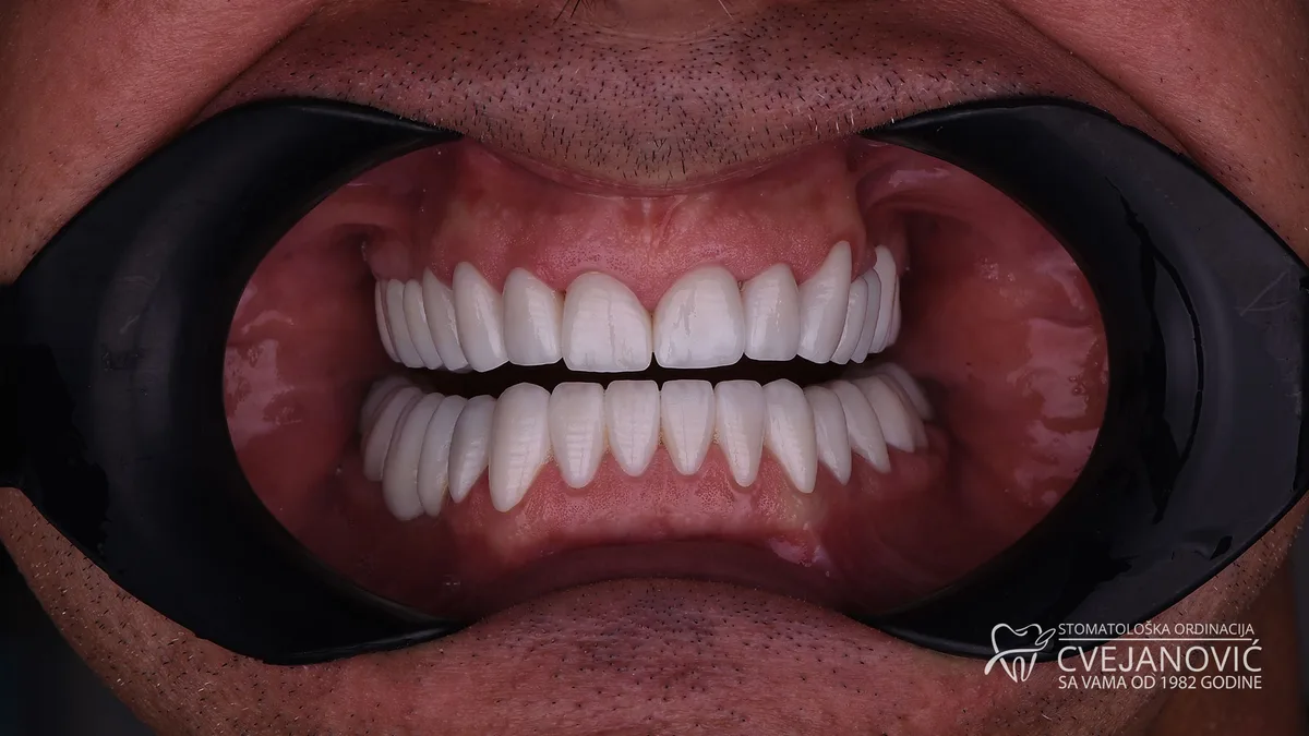 Hollywood smile za bračni par, Bleach 2 — posle