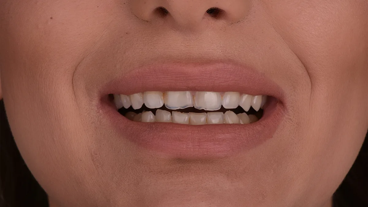 Hollywood smile – Bleach 2 boja — pre