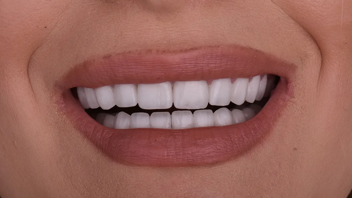 Hollywood smile – Bleach 2 boja — posle