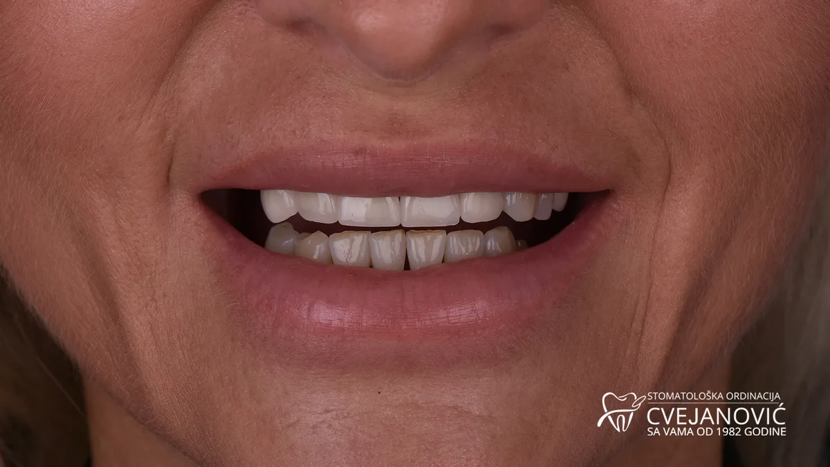 Hollywood smile, boja Bleach 4 — pre