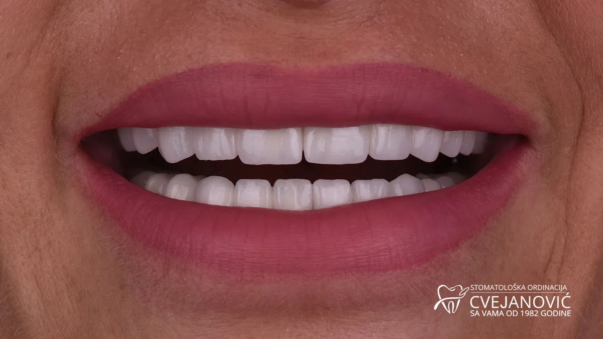 Hollywood smile, boja Bleach 4 — posle