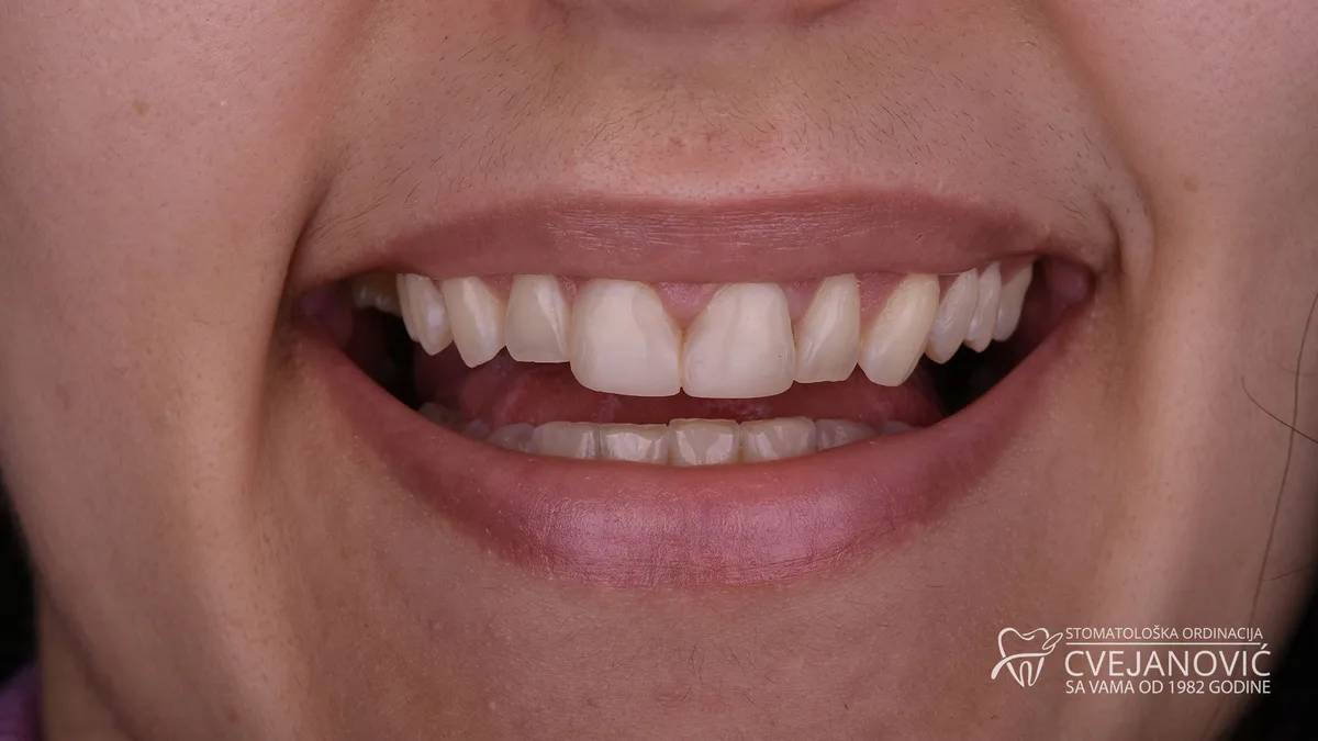 Hollywood smile, Bleach 2 — pre