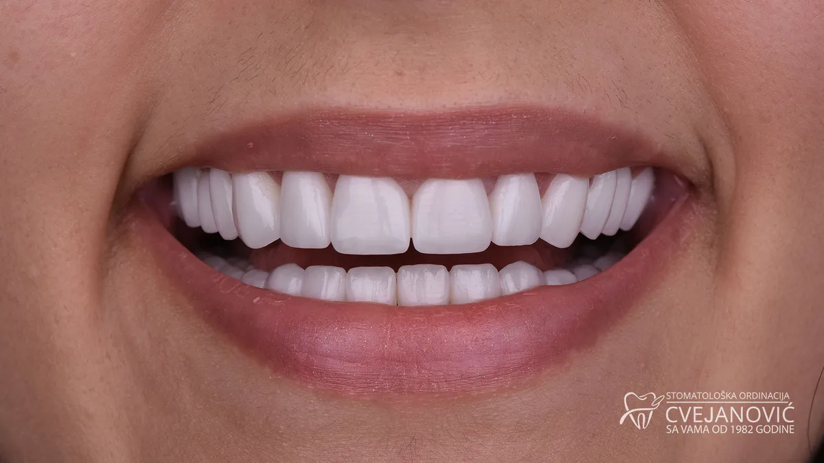 Hollywood smile, Bleach 2 — posle