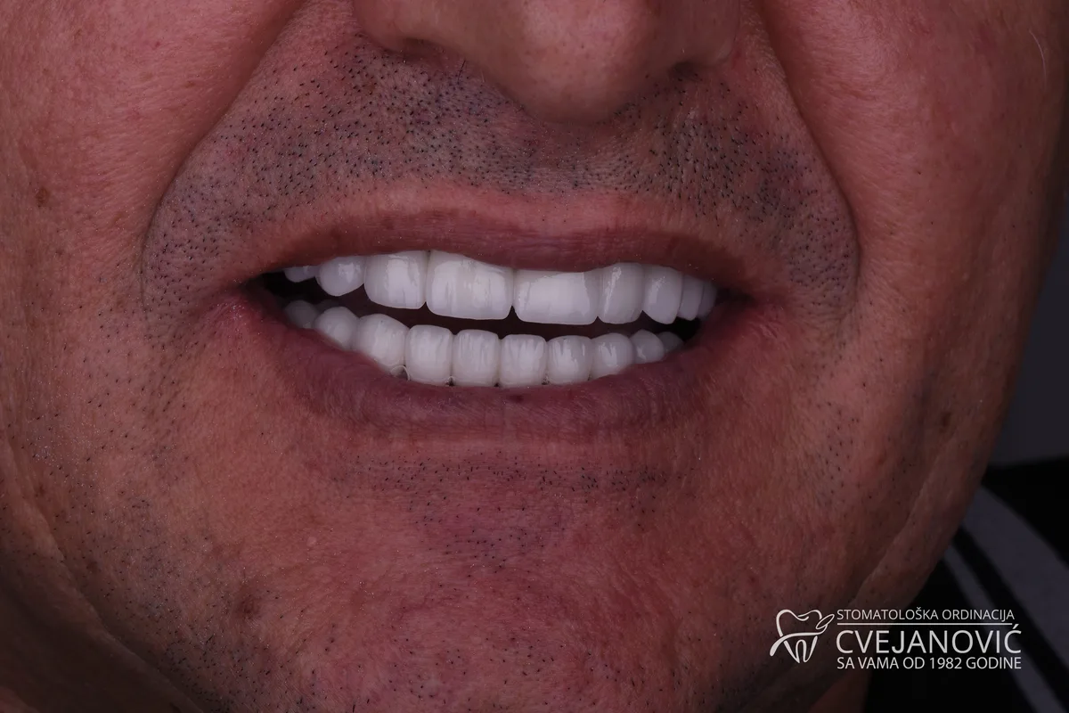 Hollywood Smile – Bleach 3 — posle
