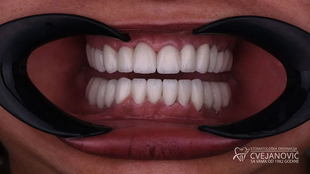 Hollywood smile – Bleach 2 — posle