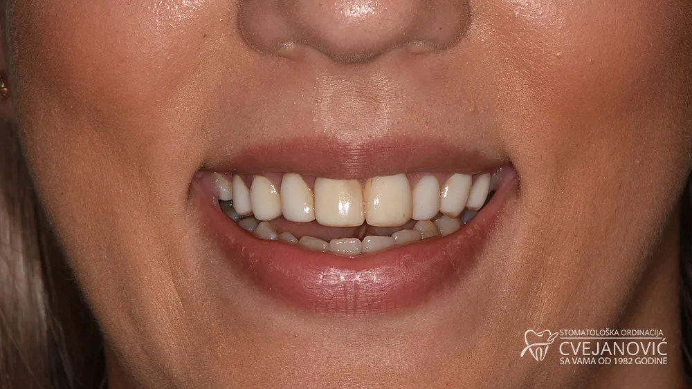 Hollywood smile, Bleach 1 — pre