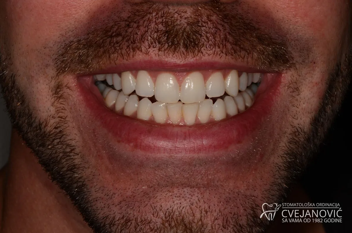 Hollywood smile, 20 keramickih faseta u obe vilice — pre