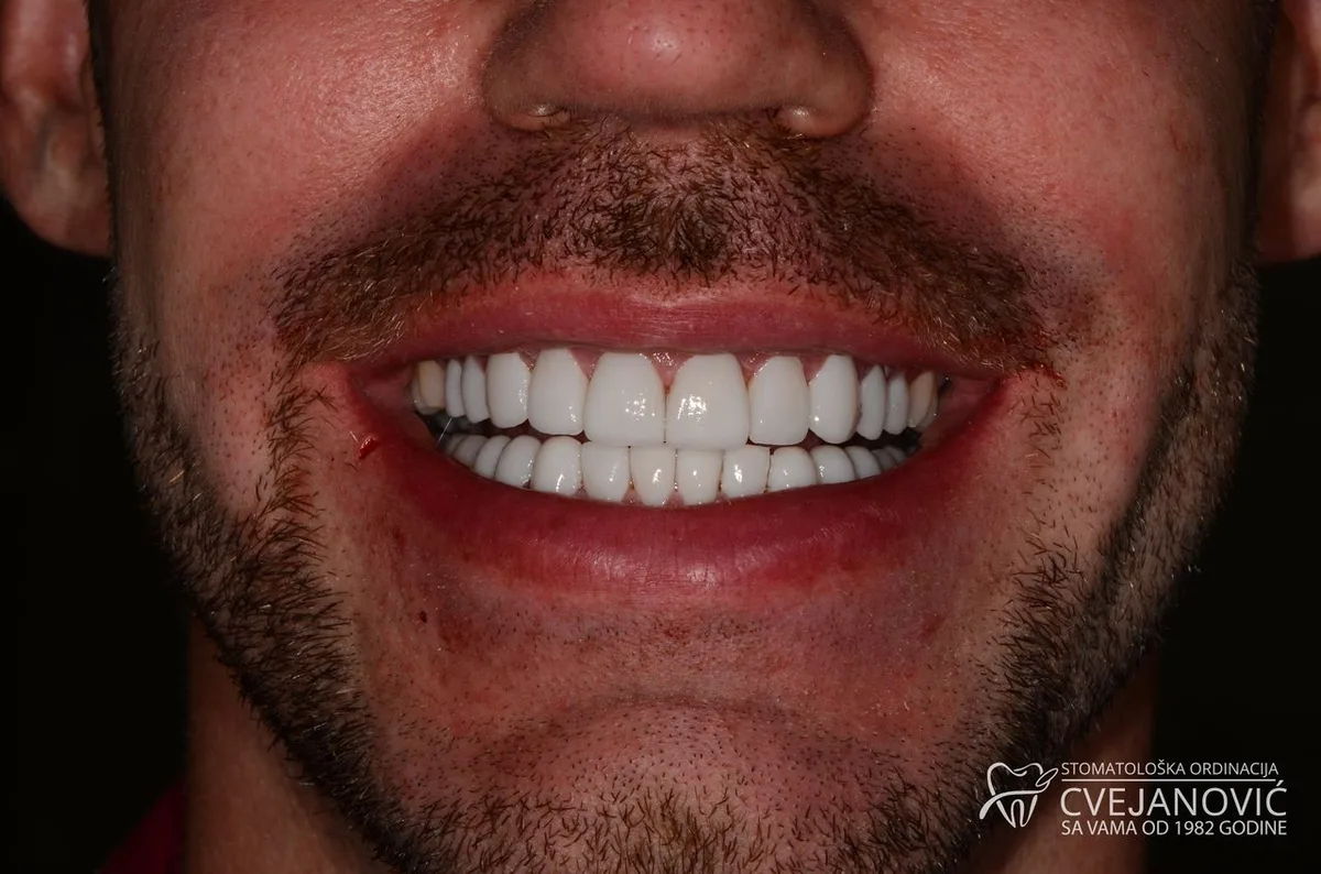 Hollywood smile, 20 keramickih faseta u obe vilice — posle