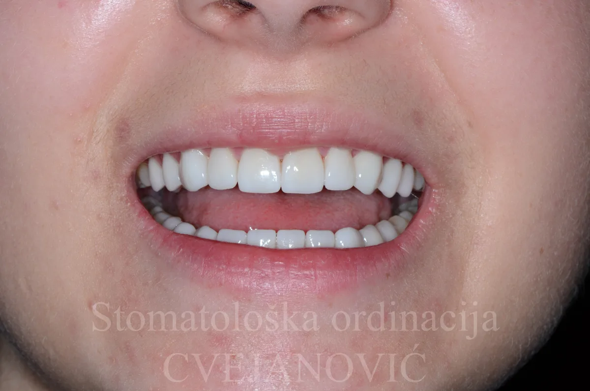 Hollywood smile, 20 keramickih faseta u obe vilice — posle