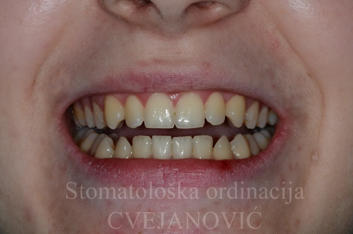 Hollywood smile, 20 keramickih faseta u obe vilice — pre