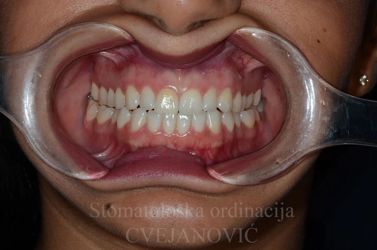 Hollywood smile, 20 keramickih faseta u obe vilice — pre