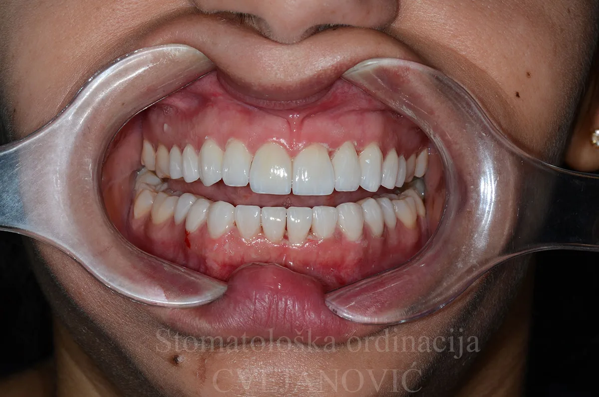 Hollywood smile, 20 keramickih faseta u obe vilice — posle