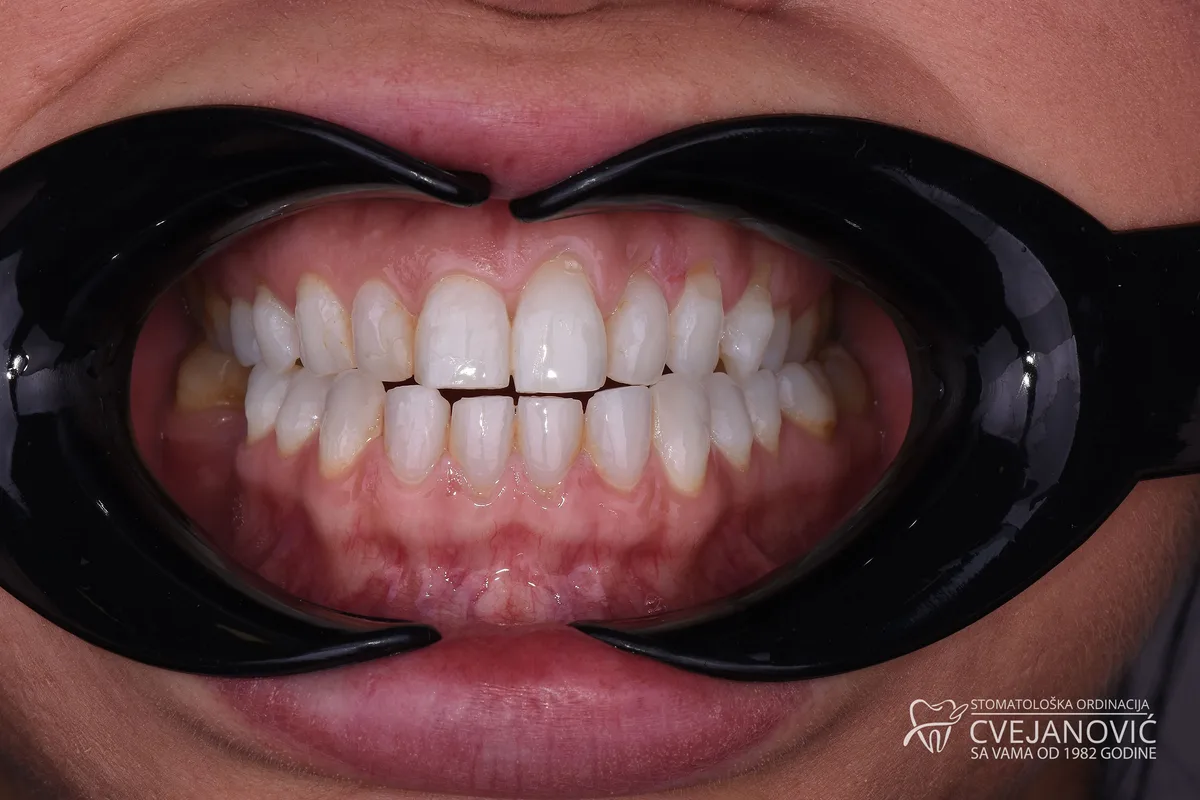 Hollywood smile, 20 keramickih faseta u obe vilice — pre
