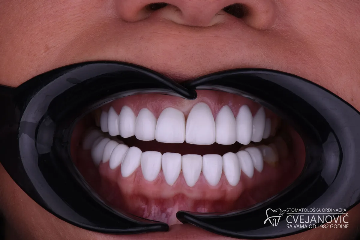 Hollywood smile, 20 keramickih faseta u obe vilice — posle