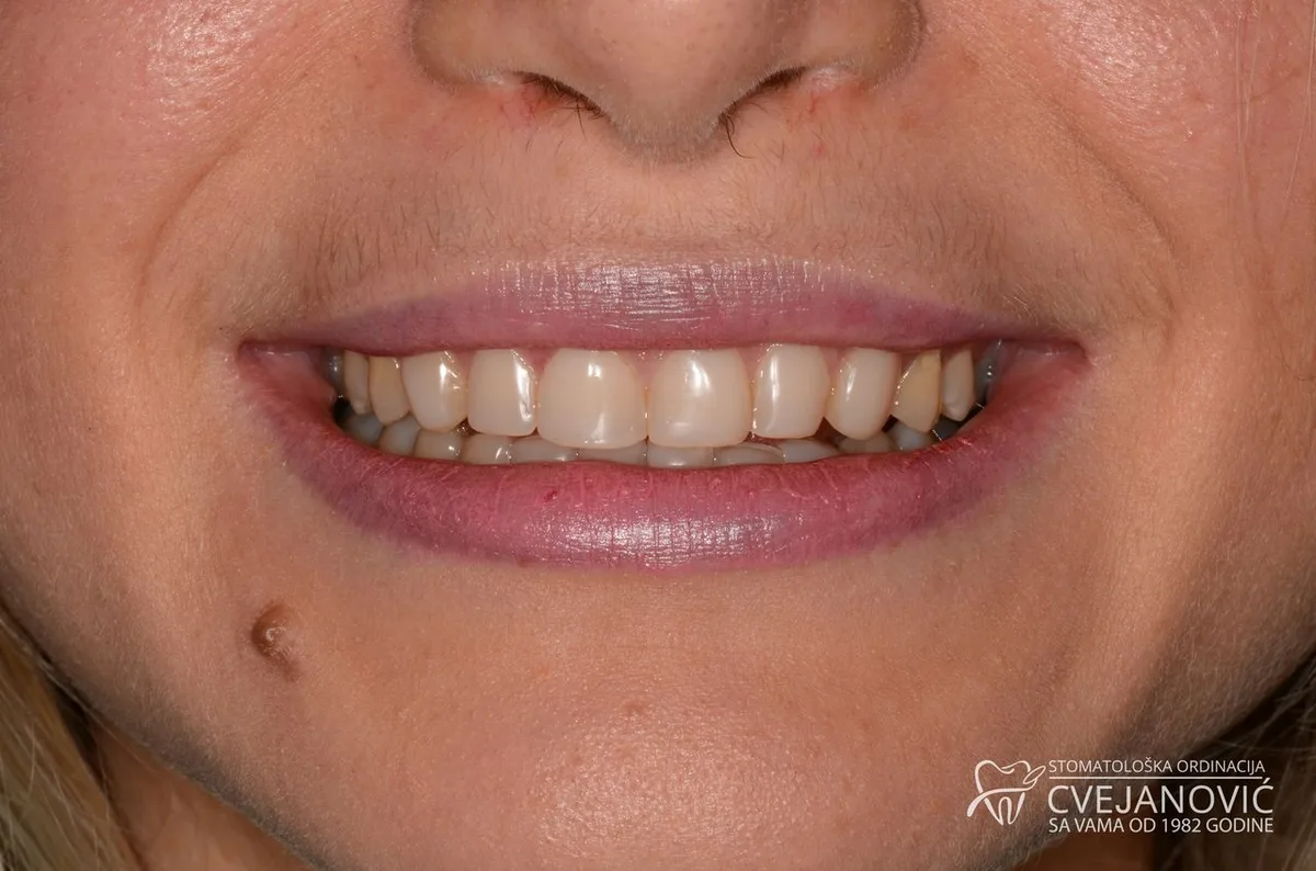 Hollywood smile, iz kompozitnih u keramičke fasete — pre