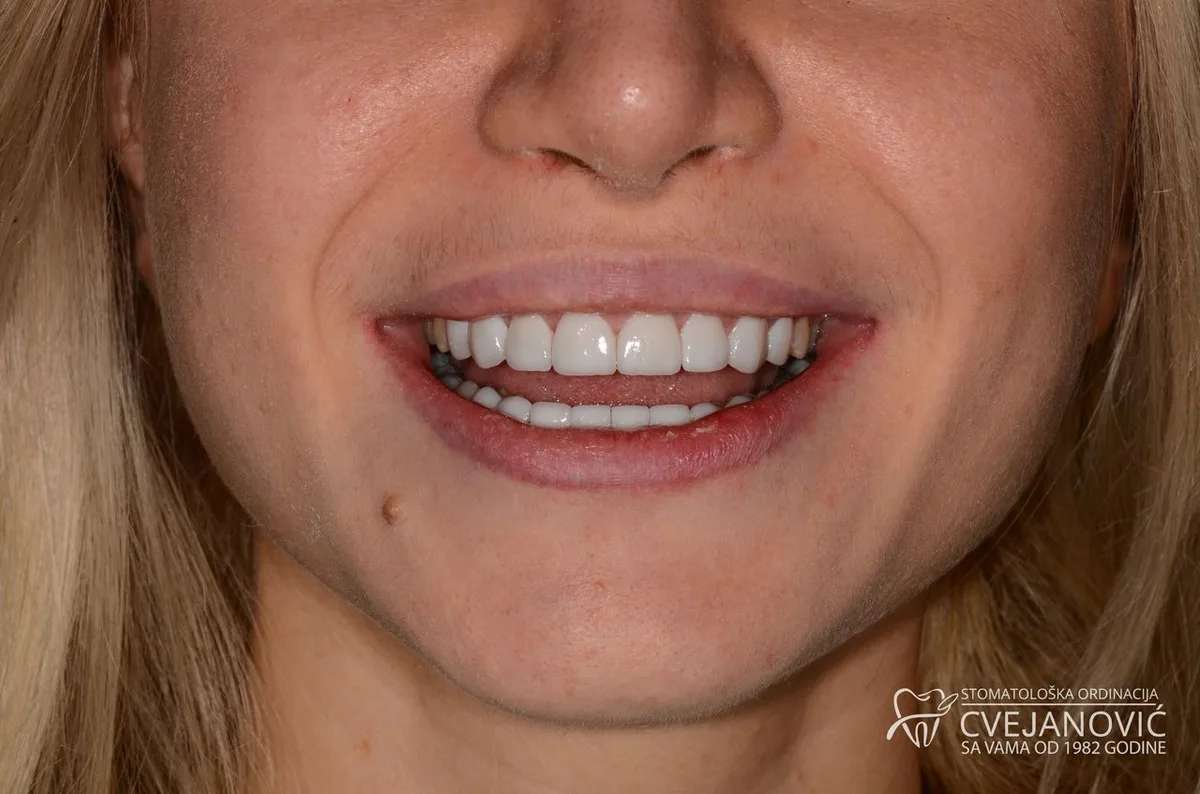 Hollywood smile, iz kompozitnih u keramičke fasete — posle
