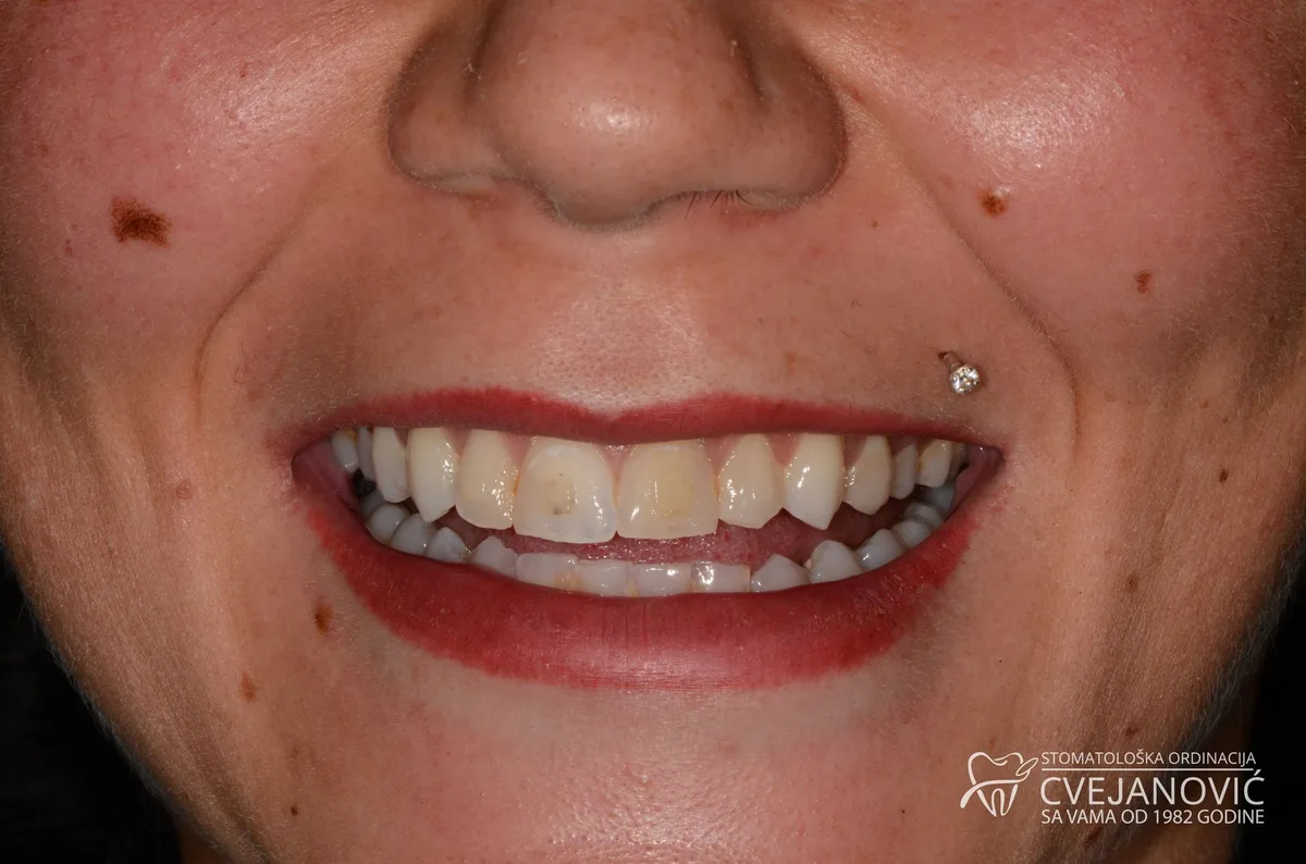Hollywood smile, uz pomoć keramičkih faseta, nakon nošenja fiksne proteze — pre