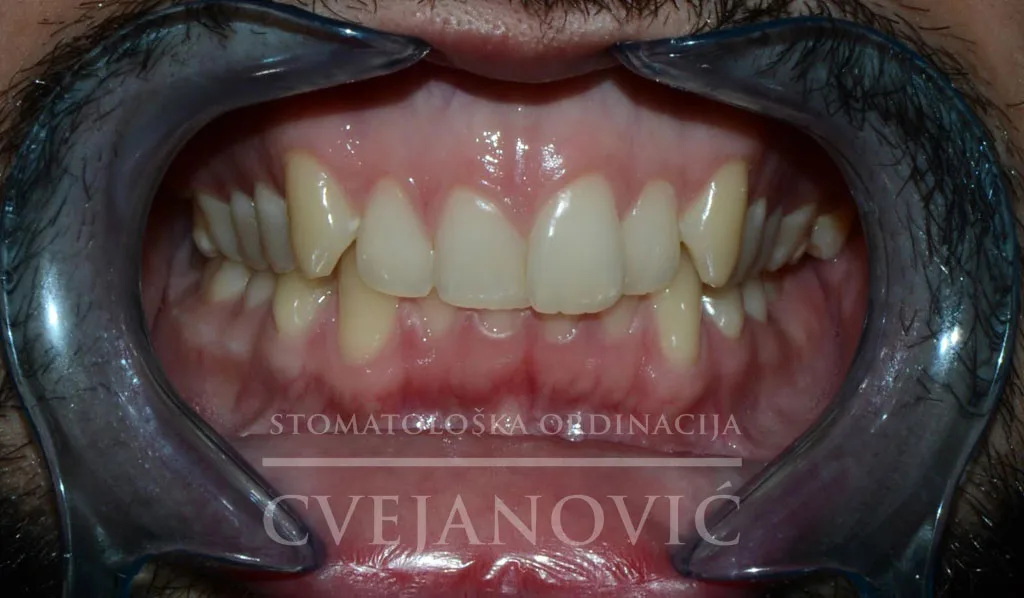 samoligirajuće bravice — pre