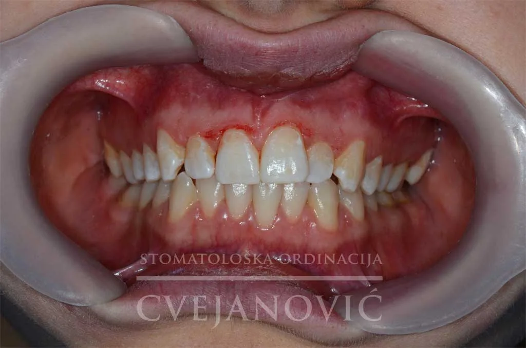 samoligirajuće bravice — pre
