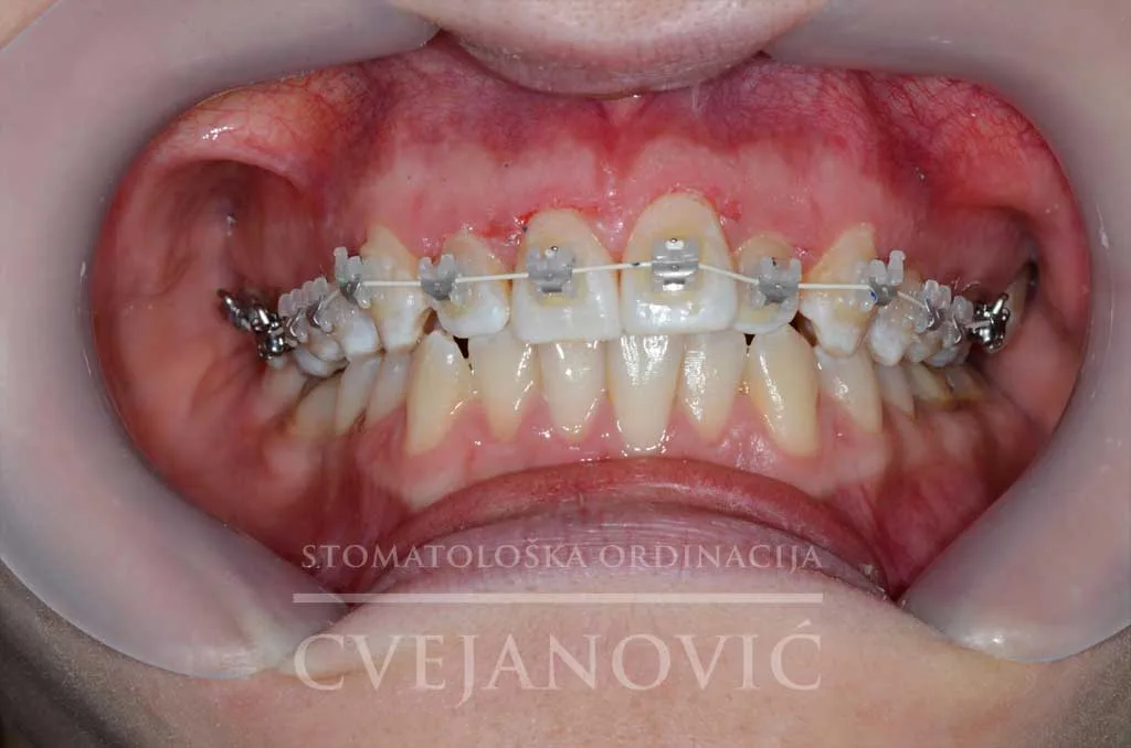 samoligirajuće bravice — posle