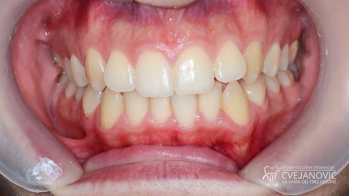 Minimetalna fiksna proteza — pre